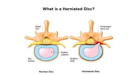 What Is Herniated Disc
